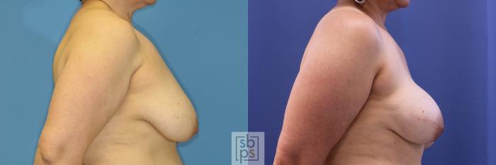 Before & After Breast Reconstruction Case 377 View #4 View in Torrance, CA