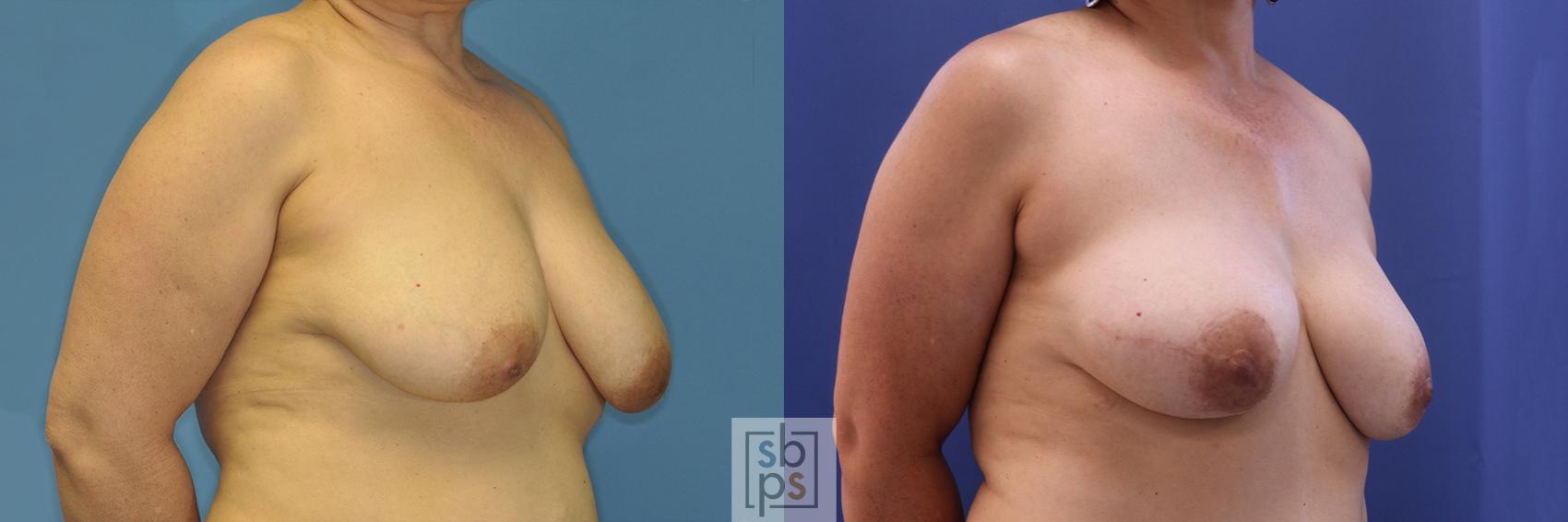 Before & After Breast Reconstruction Case 377 View #5 View in Torrance & Los Angeles, CA, CA