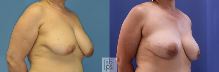Before & After Breast Reconstruction Case 377 View #5 View in Torrance, CA