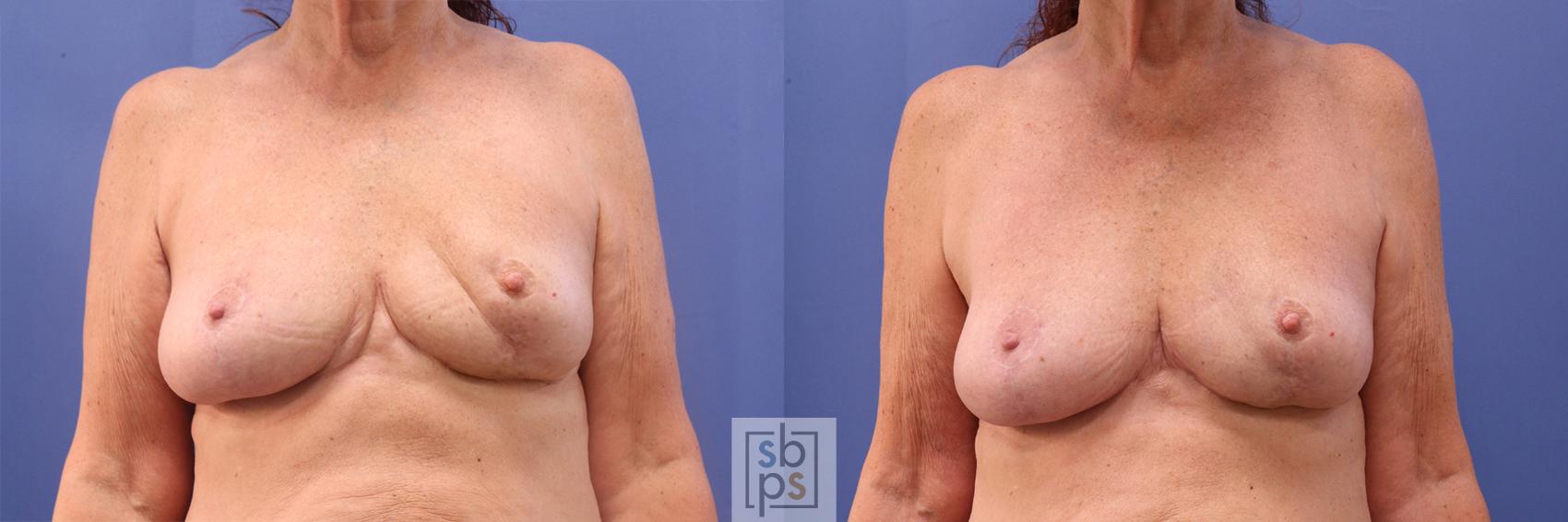 Before & After Breast Reconstruction Case 379 View #1 View in Torrance, CA