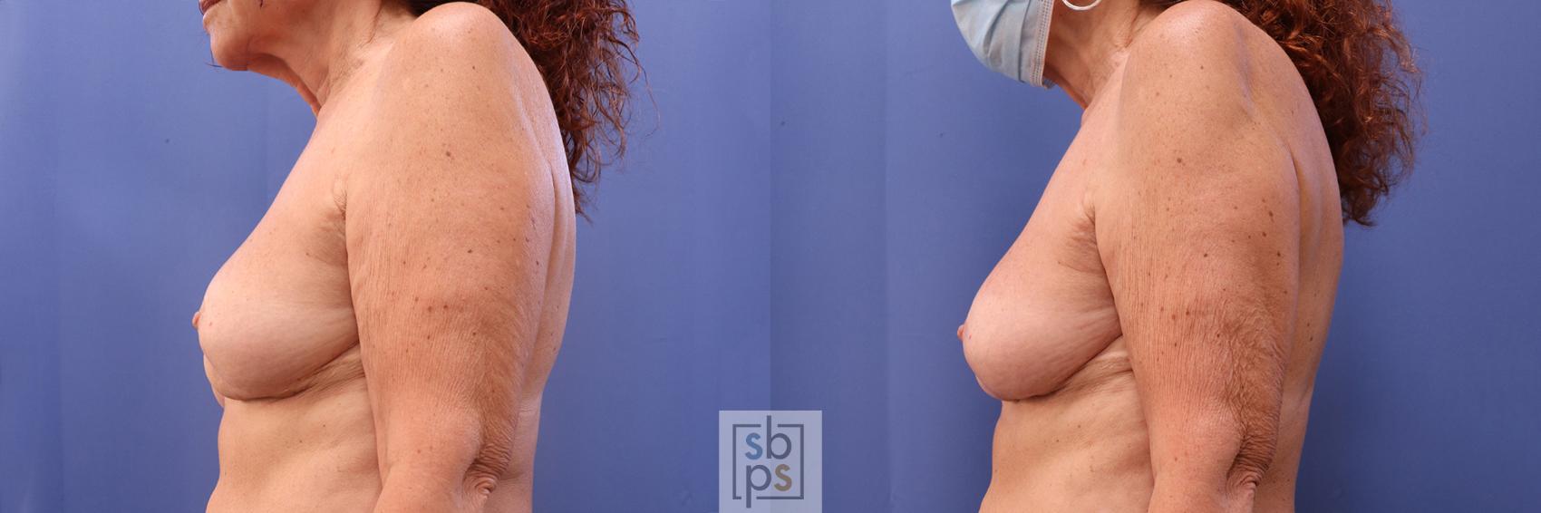 Before & After Breast Reconstruction Case 379 View #2 View in Los Angeles, Torrance & Long Beach, CA