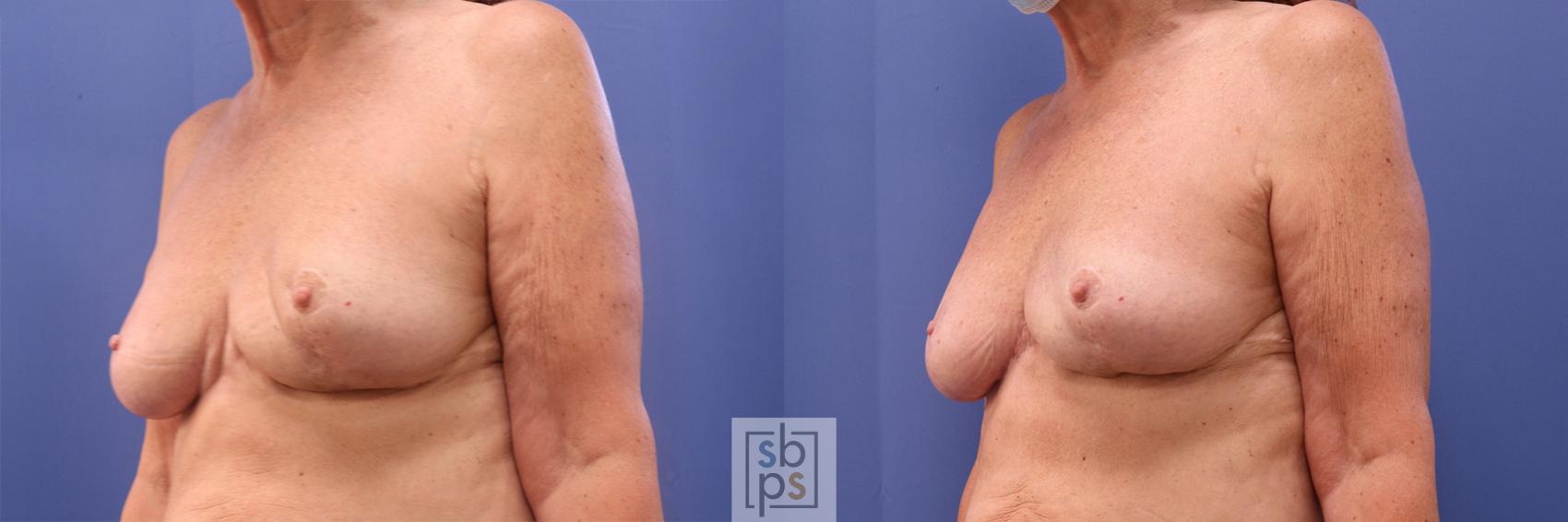 Before & After Breast Reconstruction Case 379 View #3 View in Torrance, CA