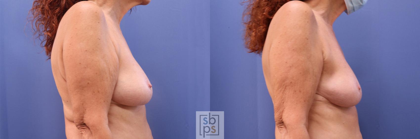 Before & After Breast Reconstruction Case 379 View #4 View in Torrance, CA