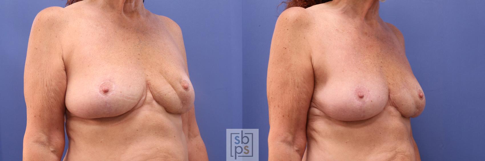 Before & After Breast Reconstruction Case 379 View #5 View in Torrance, CA