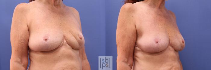 Before & After Breast Reconstruction Case 379 View #5 View in Torrance, CA