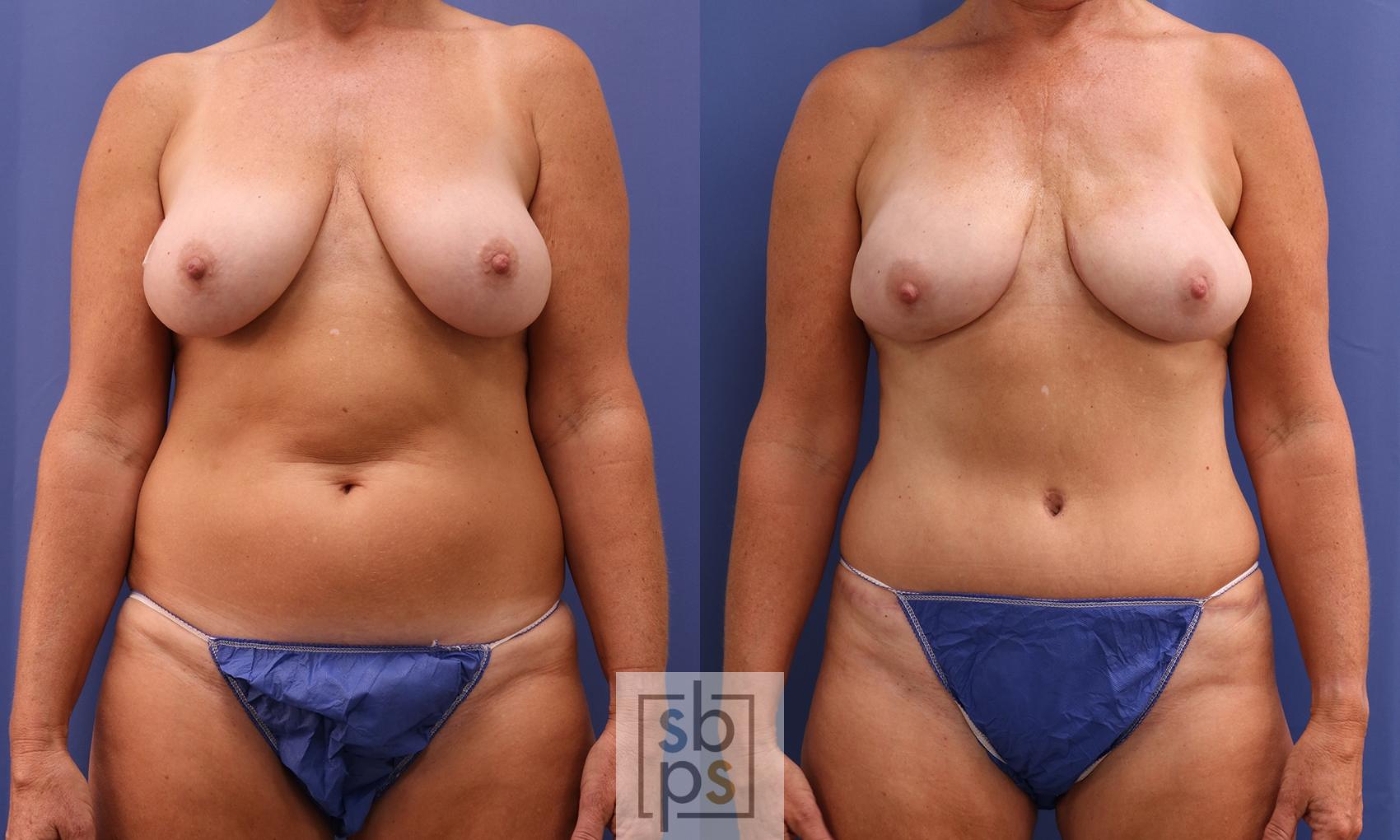 Before & After Breast Reconstruction Case 400 Front View in Torrance, CA