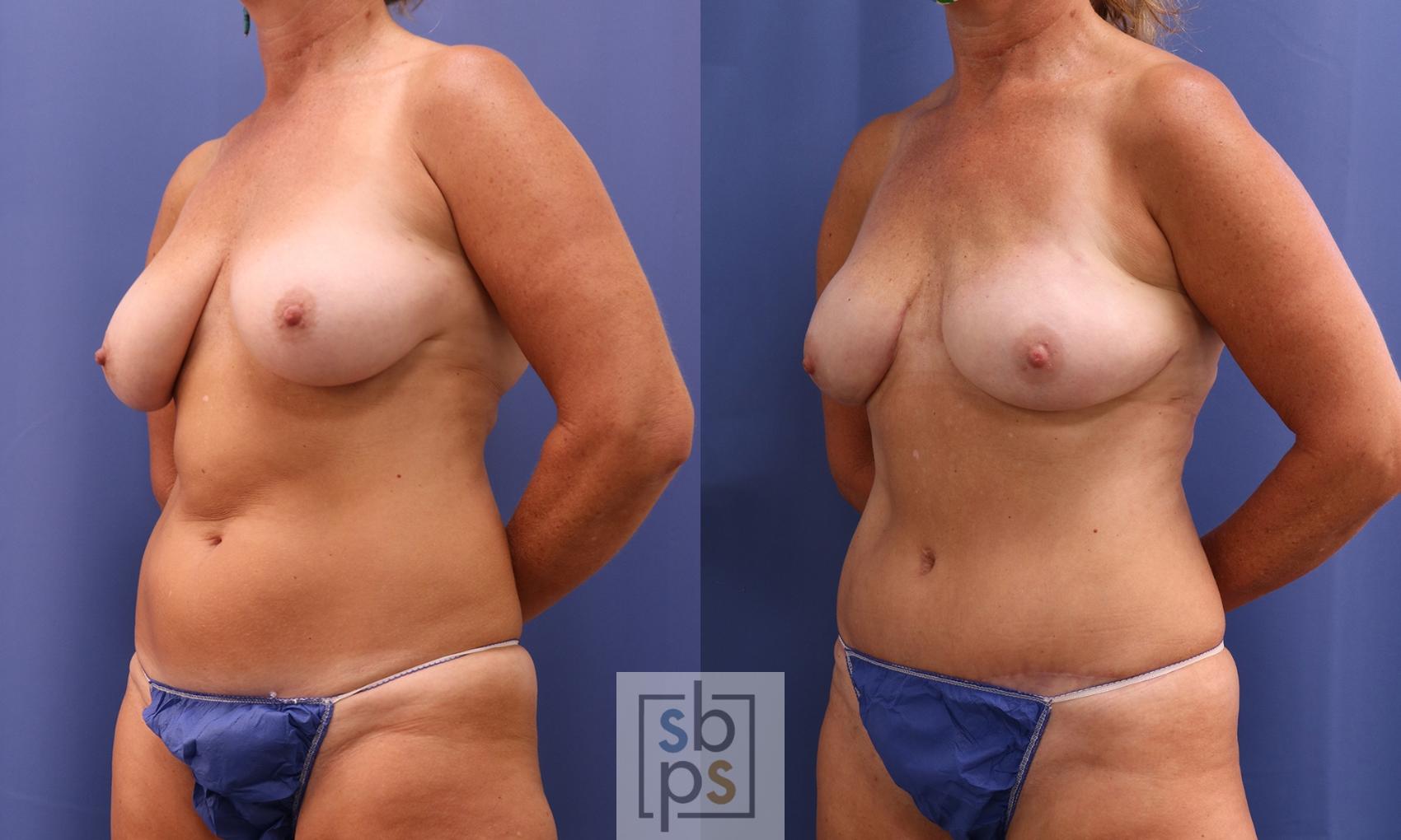 Before & After Breast Reconstruction Case 400 Left Oblique View in Torrance & Los Angeles, CA, CA