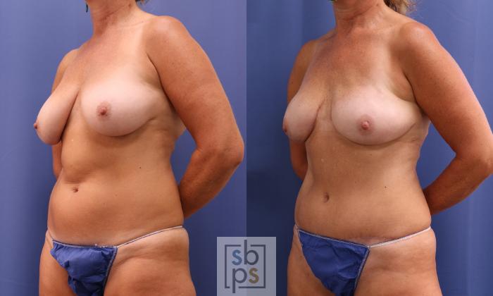 Before & After Breast Reconstruction Case 400 Left Oblique View in Torrance, CA