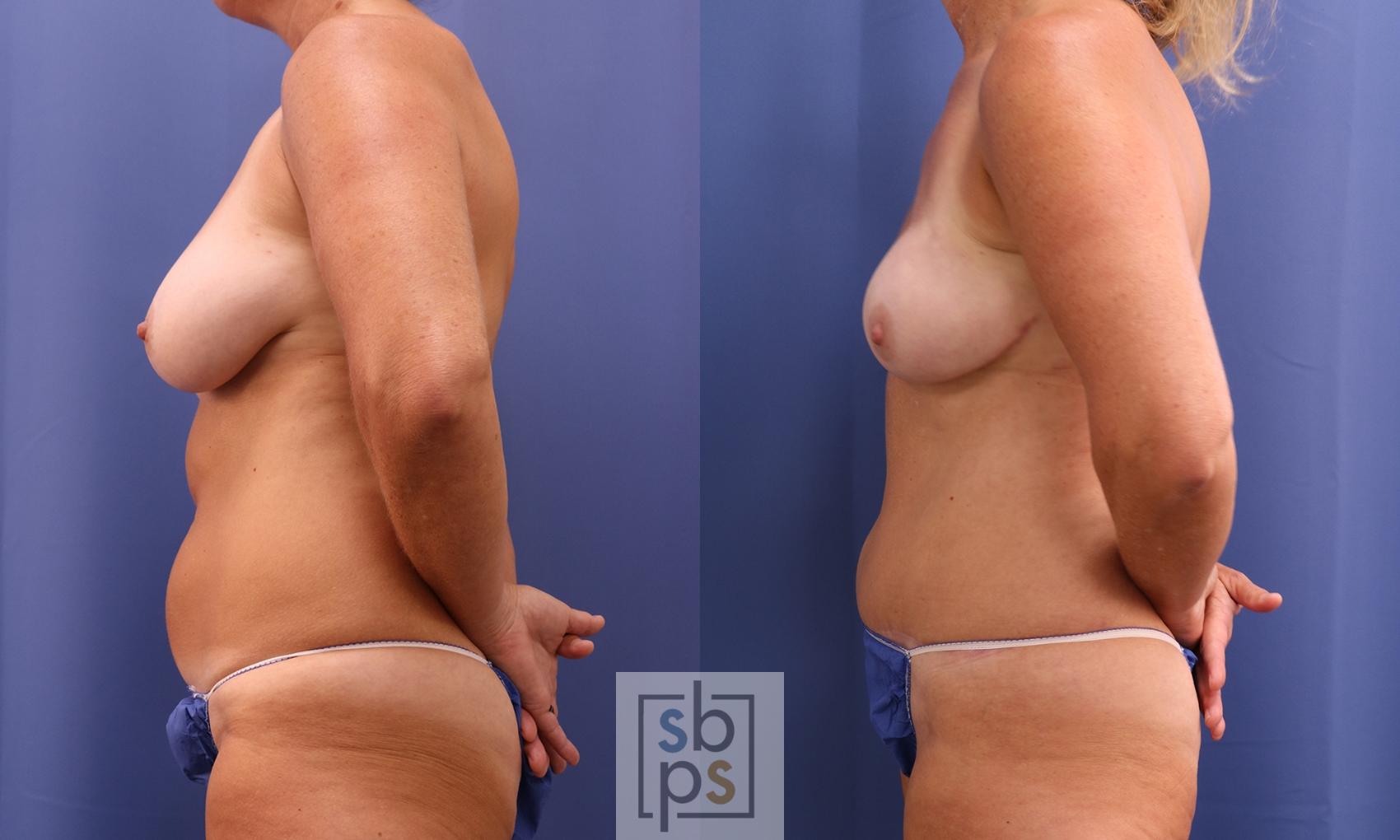 Before & After Breast Reconstruction Case 400 Left Side View in Torrance & Los Angeles, CA, CA