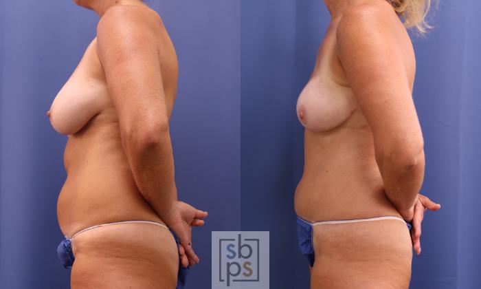 Before & After Breast Reconstruction Case 400 Left Side View in Torrance, CA