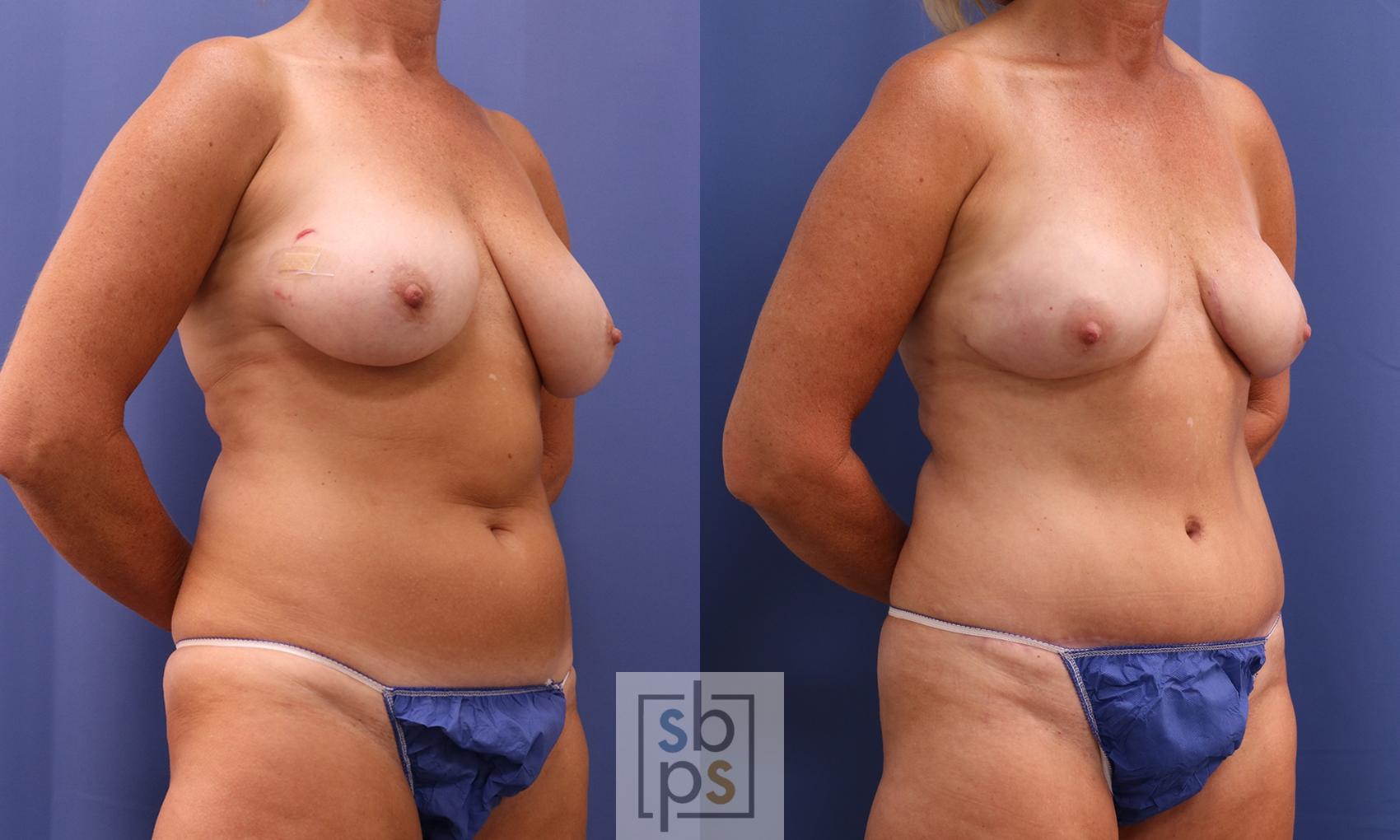 Before & After Breast Reconstruction Case 400 Right Oblique View in Torrance & Los Angeles, CA, CA