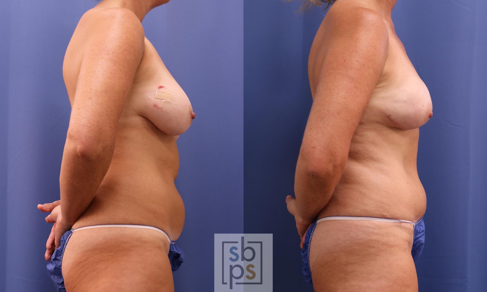 Before & After Breast Reconstruction Case 400 Right Side View in Torrance & Los Angeles, CA, CA