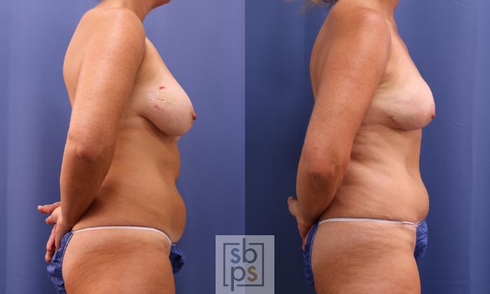 Before & After Breast Reconstruction Case 400 Right Side View in Torrance, CA