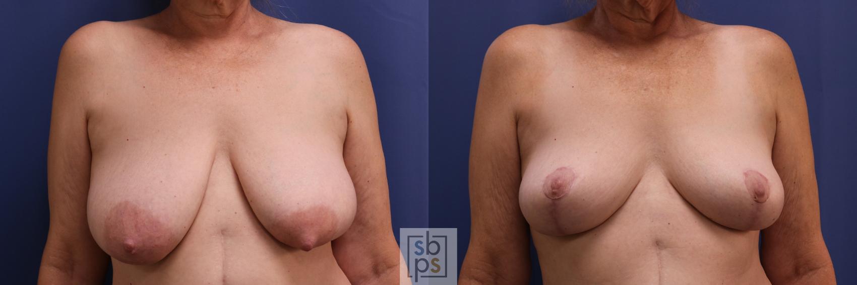 Before & After Breast Reconstruction Case 408 Front View in Torrance, CA