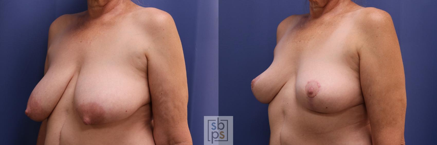 Before & After Breast Reconstruction Case 408 Left Oblique View in Los Angeles, Torrance & Long Beach, CA