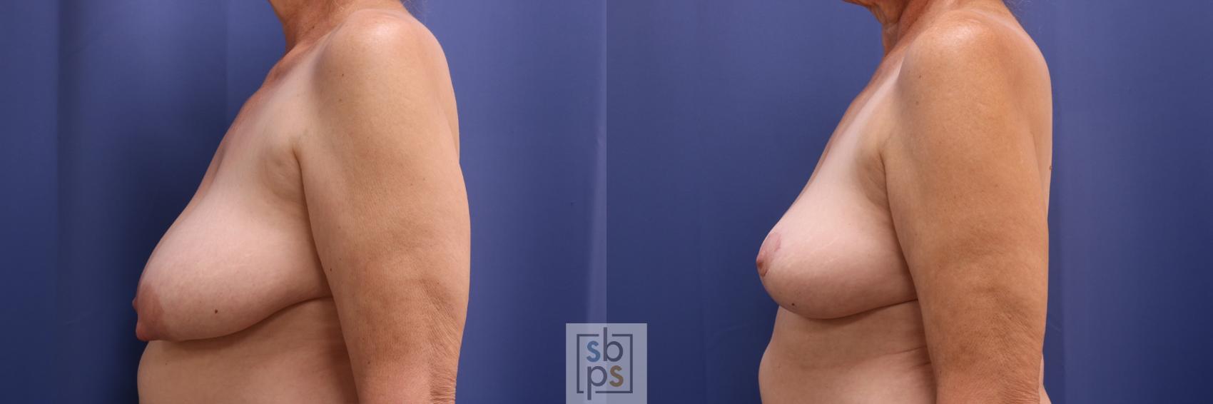 Before & After Breast Reconstruction Case 408 Left Side View in Los Angeles, Torrance & Long Beach, CA