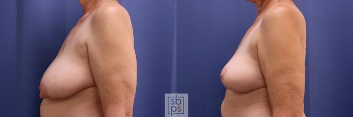 Before & After Breast Reconstruction Case 408 Left Side View in Torrance, CA