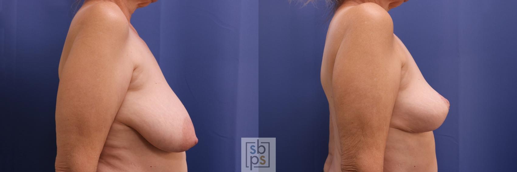 Before & After Breast Reconstruction Case 408 Right Side View in Los Angeles, Torrance & Long Beach, CA
