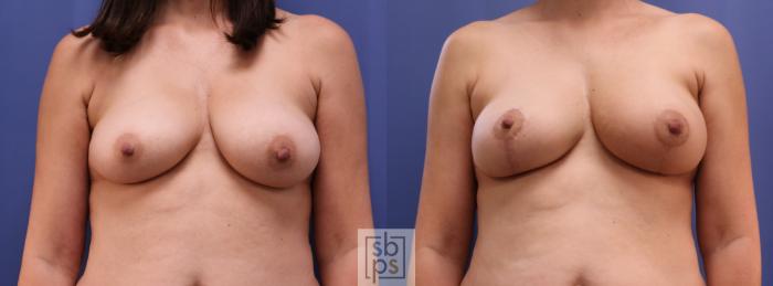 Before & After Breast Reconstruction Case 411 Front View in Torrance, CA