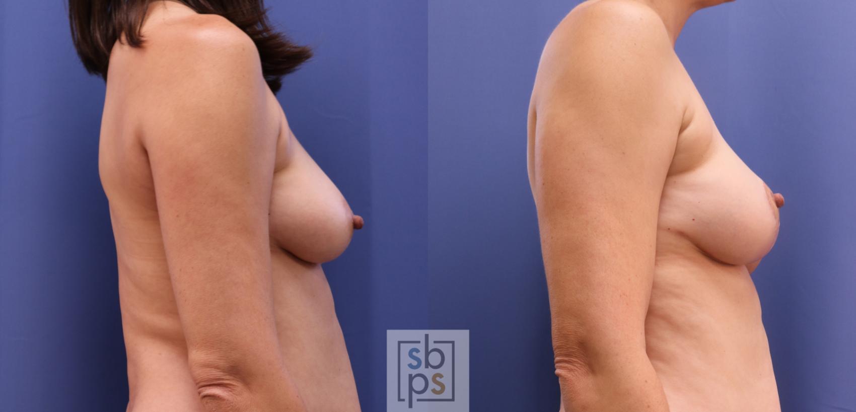 Before & After Breast Reconstruction Case 411 Right Side View in Torrance & Los Angeles, CA, CA