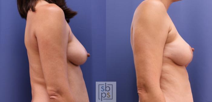 Before & After Breast Reconstruction Case 411 Right Side View in Torrance, CA