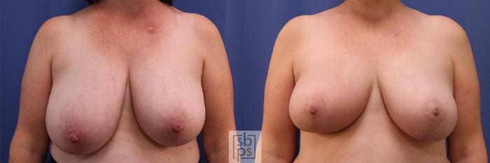 Before & After Breast Reconstruction Case 416 Front View in Torrance, CA