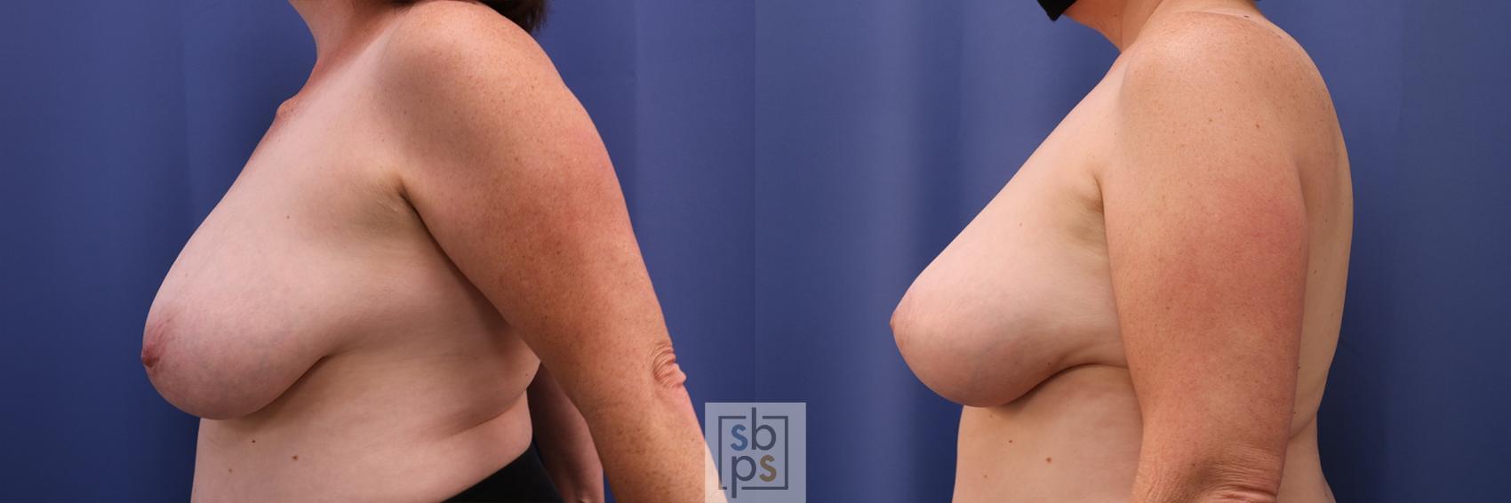 Before & After Breast Reconstruction Case 416 Left Side View in Torrance & Los Angeles, CA, CA