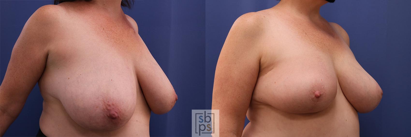 Before & After Breast Reconstruction Case 416 Right Oblique View in Torrance & Los Angeles, CA, CA