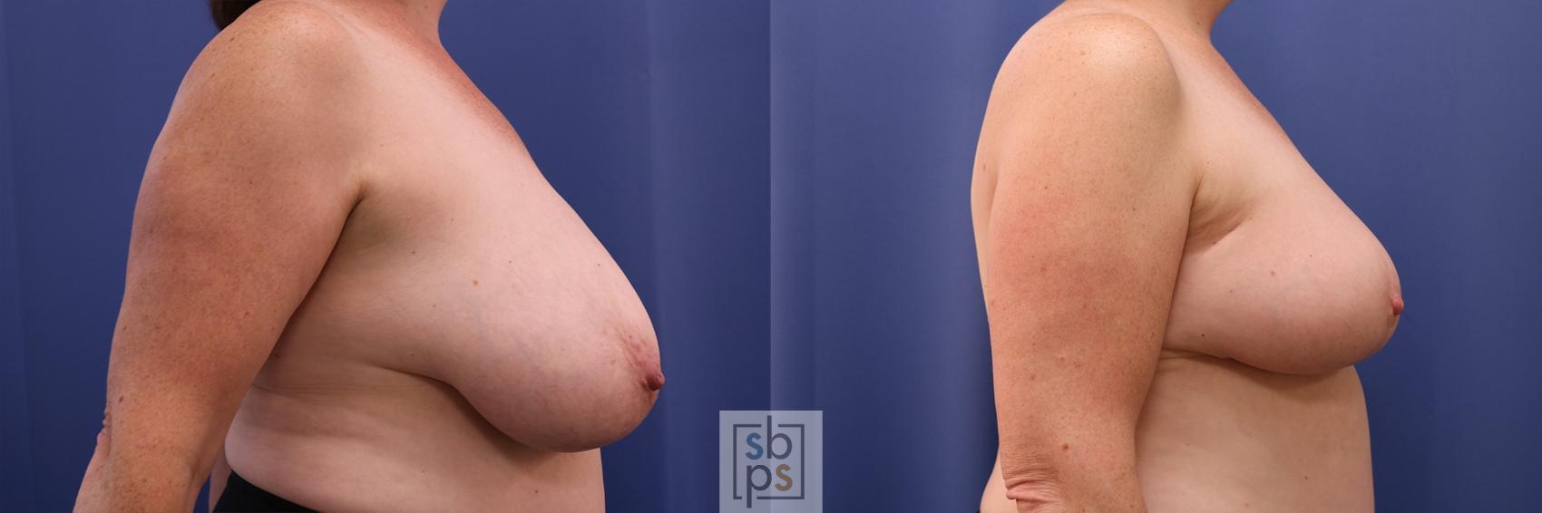 Before & After Breast Reconstruction Case 416 Right Side View in Torrance & Los Angeles, CA, CA