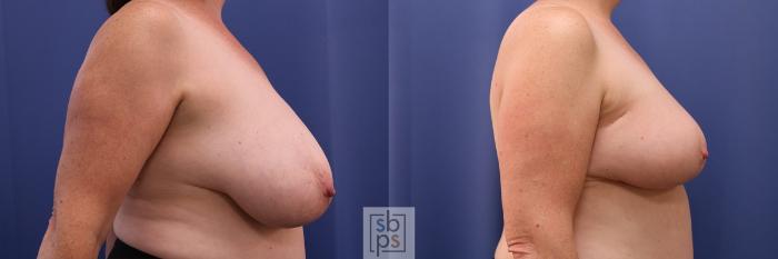 Before & After Breast Reconstruction Case 416 Right Side View in Torrance, CA