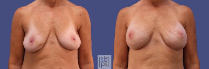 Before & After Breast Reconstruction Case 421 Front View in Torrance, CA