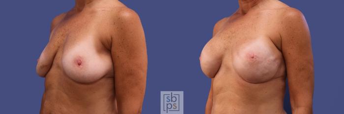 Before & After Breast Reconstruction Case 421 Left Oblique View in Torrance, CA
