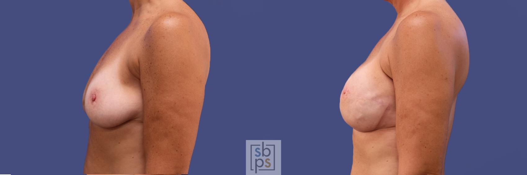 Before & After Breast Reconstruction Case 421 Left Side View in Torrance & Los Angeles, CA, CA