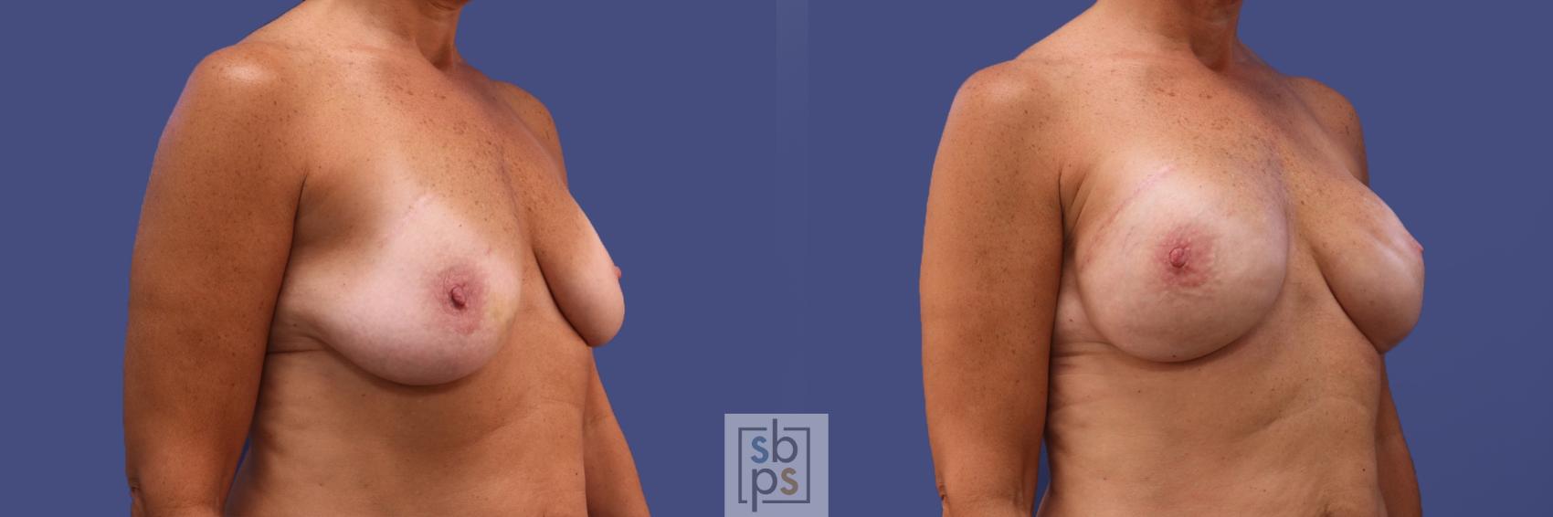 Before & After Breast Reconstruction Case 421 Right Oblique View in Torrance & Los Angeles, CA, CA