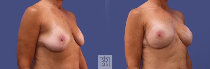 Before & After Breast Reconstruction Case 421 Right Oblique View in Torrance, CA