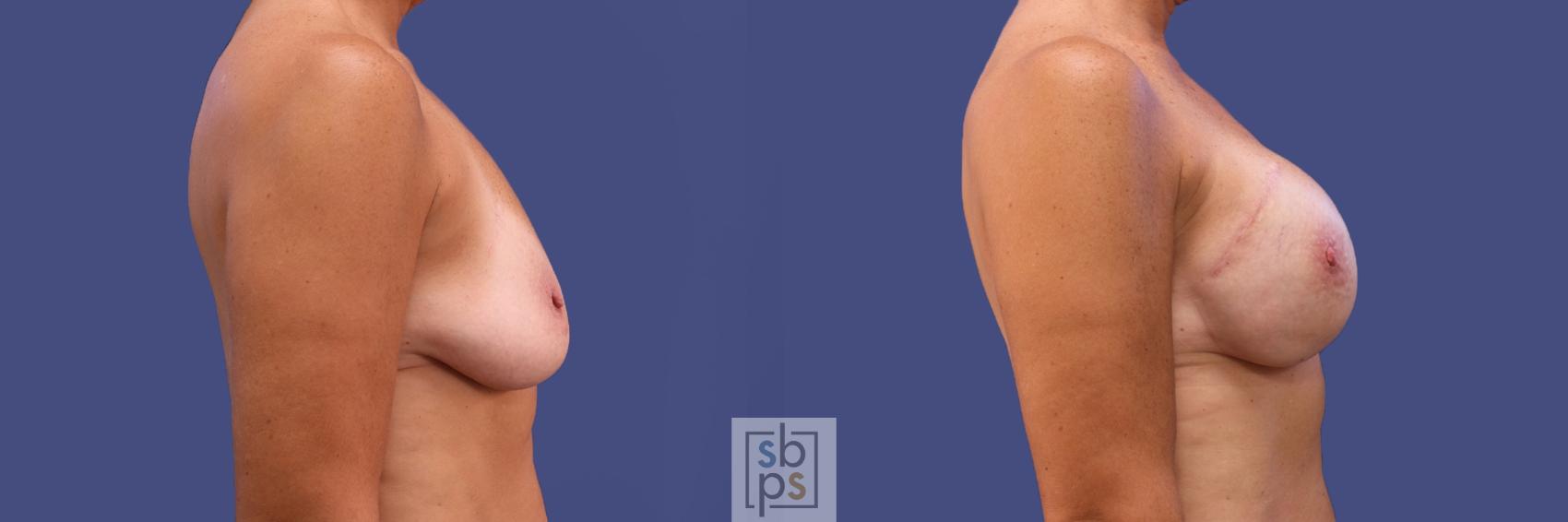 Before & After Breast Reconstruction Case 421 Right Side View in Torrance & Los Angeles, CA, CA