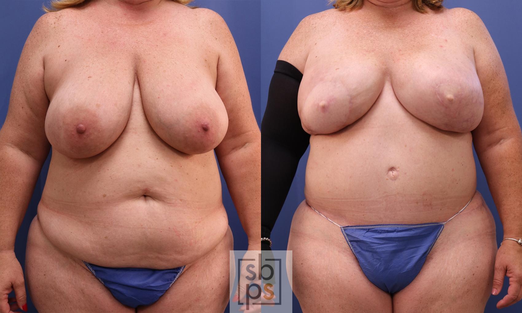 Before & After Breast Reconstruction Case 433 Front View in Torrance, CA