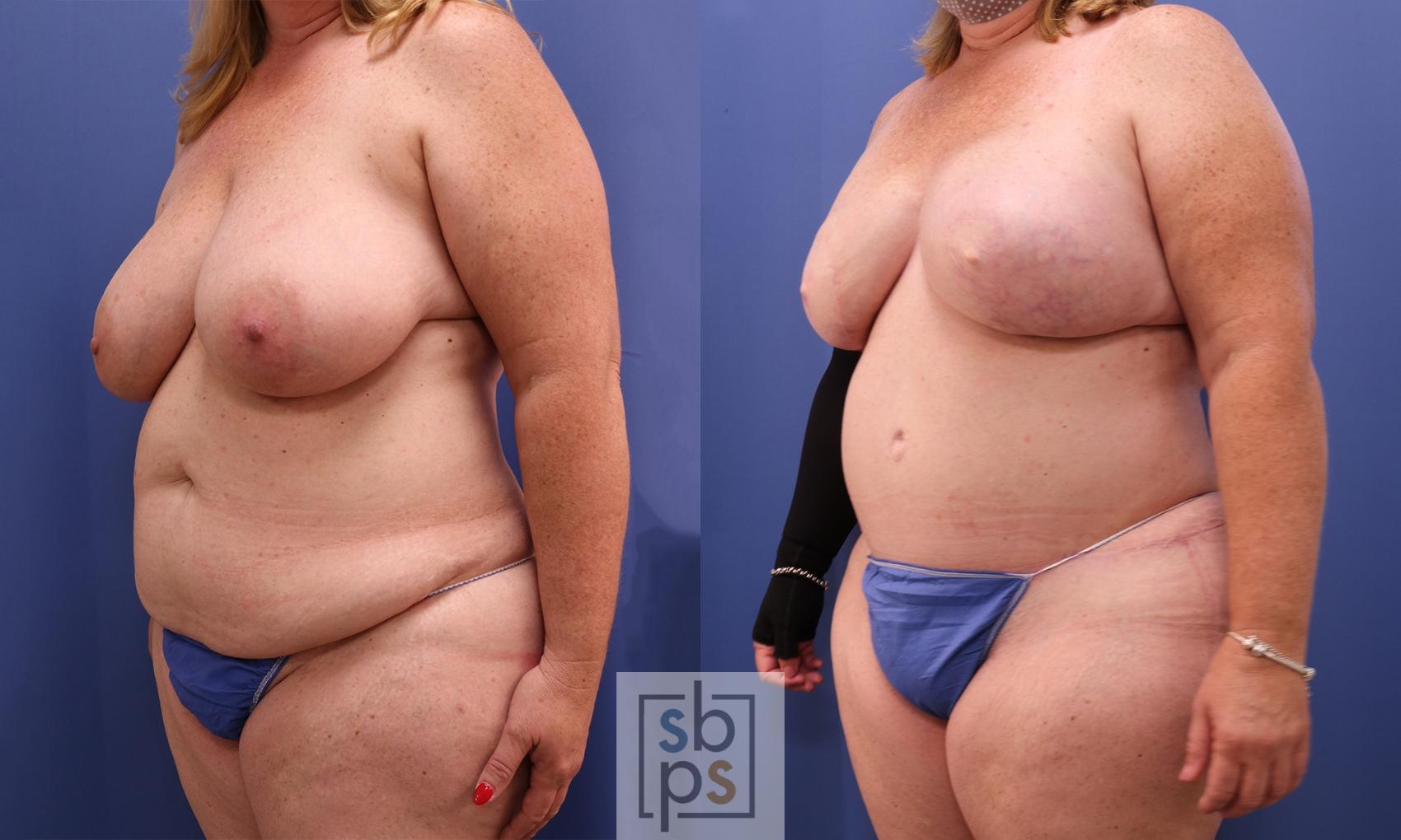 Before & After Breast Reconstruction Case 433 Left Oblique View in Torrance & Los Angeles, CA, CA