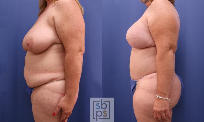Before & After Breast Reconstruction Case 433 Left Side View in Torrance, CA