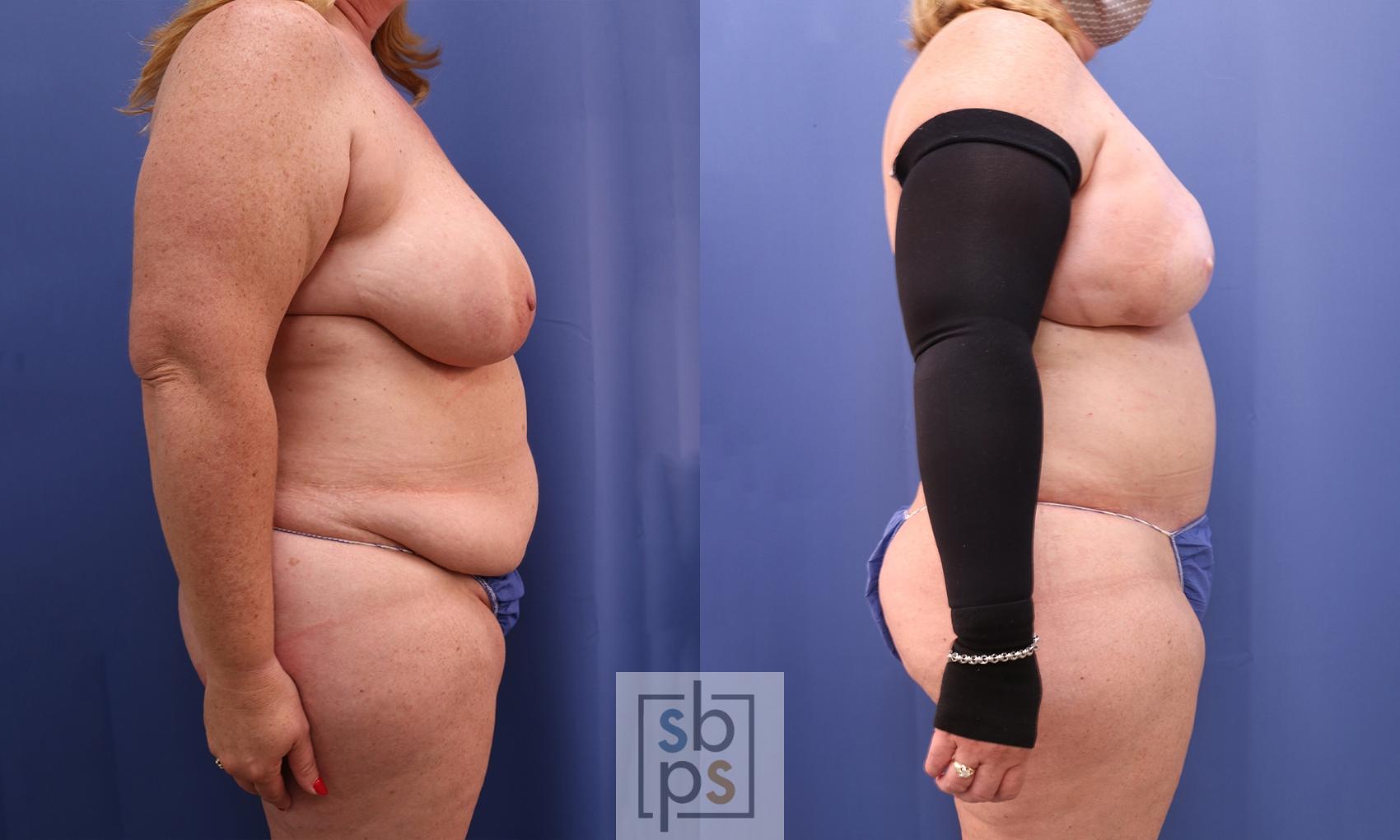 Before & After Breast Reconstruction Case 433 Right Side View in Torrance & Los Angeles, CA, CA