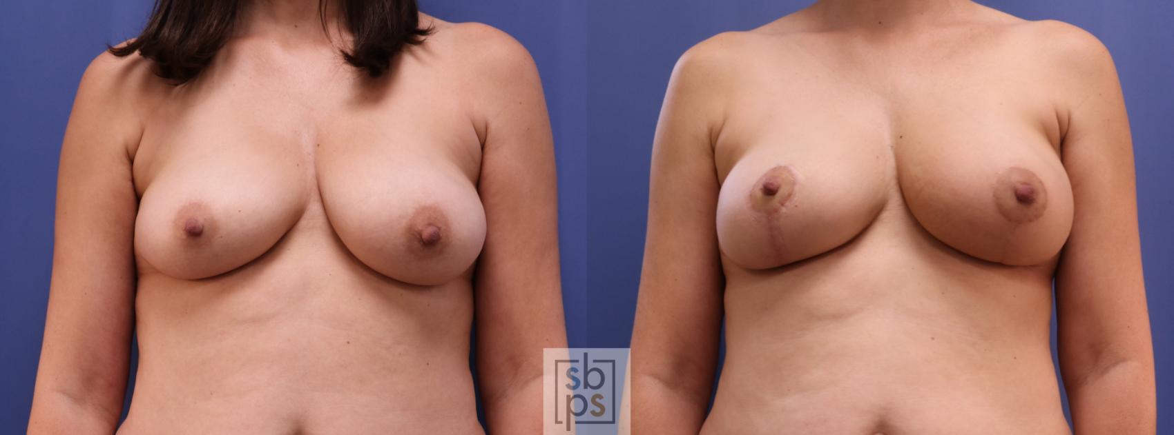 Before & After Breast Reconstruction Case 442 Front View in Torrance, CA