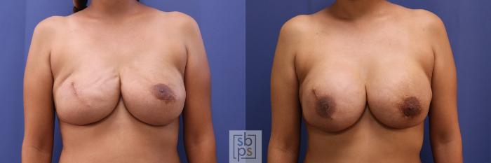 Before & After Breast Reconstruction Case 460 Front View in Torrance, CA