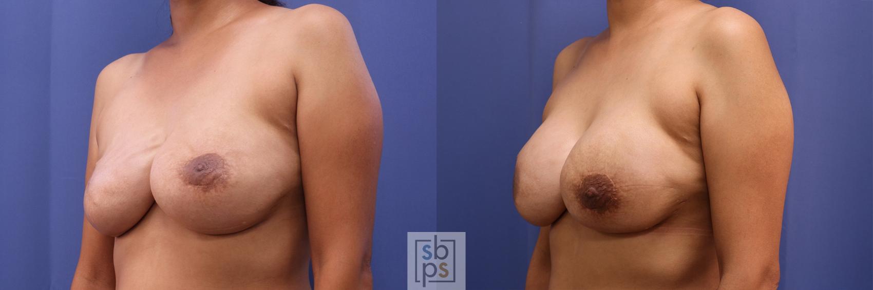 Before & After Breast Reconstruction Case 460 Left Oblique View in Torrance & Los Angeles, CA, CA