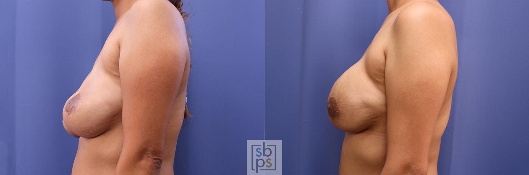 Before & After Breast Reconstruction Case 460 Left Side View in Torrance & Los Angeles, CA, CA