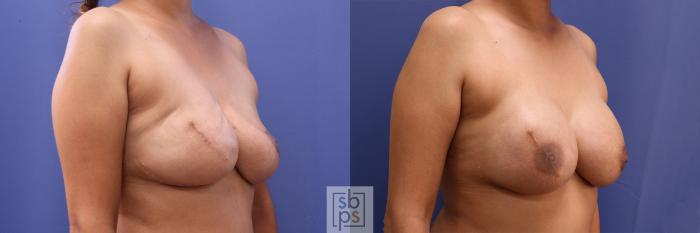 Before & After Breast Reconstruction Case 460 Right Oblique View in Torrance, CA