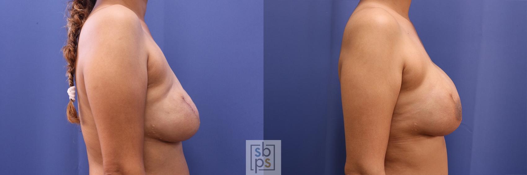 Before & After Breast Reconstruction Case 460 Right Side View in Torrance & Los Angeles, CA, CA