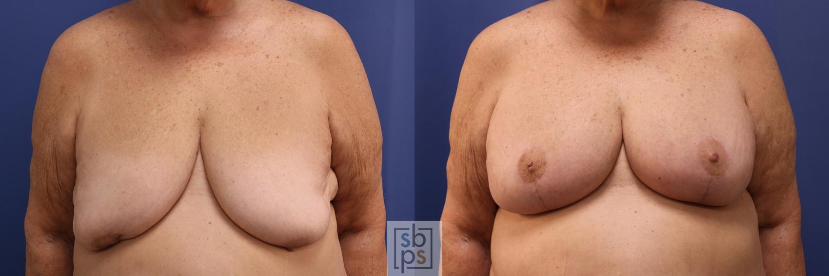 Before & After Breast Reconstruction Case 493 Front View in Torrance, CA