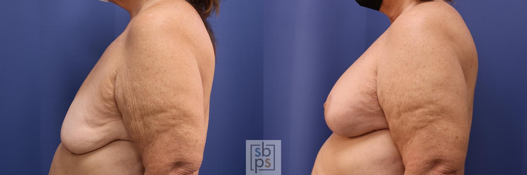Before & After Breast Reconstruction Case 493 Left Side View in Torrance & Los Angeles, CA, CA