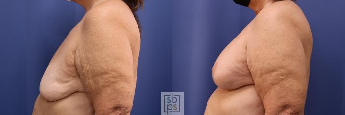 Before & After Breast Reconstruction Case 493 Left Side View in Torrance, CA