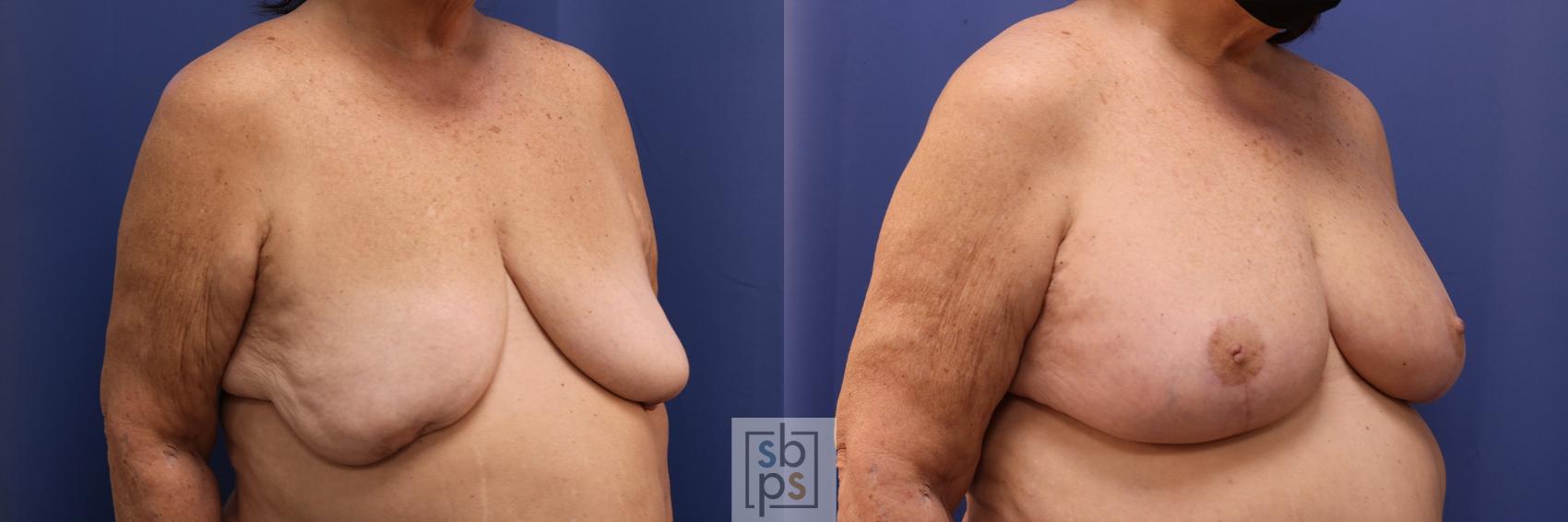 Before & After Breast Reconstruction Case 493 Right Oblique View in Torrance & Los Angeles, CA, CA